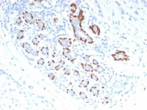 Immunohistochemical analysis of formalin-fixed, paraffin-embedded human breast carcinoma using Anti-p40 Antibody