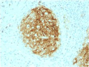 Immunohistochemical analysis of formalin-fixed, paraffin-embedded human follicular dendritic cell sarcoma using Anti-CD21 Antibody [CR2/1953]