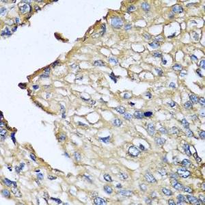 Immunohistochemistry analysis of paraffin-embedded human prostate cancer using Anti-ASIP Antibody (A12031) at a dilution of 1:100 (40X lens). Perform microwave antigen retrieval with 10 mM PBS buffer pH 7.2 before commencing with IHC staining protocol