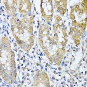 Immunohistochemistry analysis of paraffin-embedded human gastric cancer using Anti-ASIP Antibody (A12031) at a dilution of 1:100 (40X lens). Perform microwave antigen retrieval with 10 mM PBS buffer pH 7.2 before commencing with IHC staining protocol