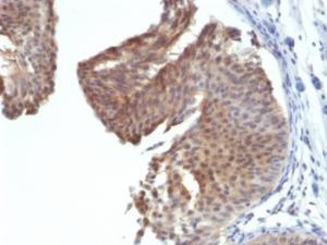 Immunohistochemical analysis of formalin-fixed, paraffin-embedded human bladder carcinoma using Anti-Cytokeratin 6 Antibody [KRT6/1702]