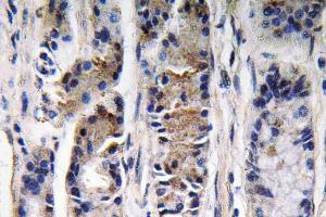 Immunohistochemical analysis of paraffin-embedded human lung carcinoma tissue using Anti-Pepsin C Antibody