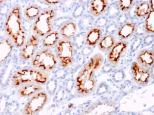 Immunohistochemical analysis of formalin-fixed, paraffin-embedded human renal cell carcinoma using Anti-TNFSF9 Antibody [CD137L/1547]