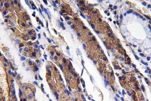 Immunohistochemical analysis of paraffin-embedded human lung carcinoma tissue using Anti-Pepsin A Antibody