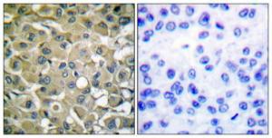 Immunohistochemical analysis of paraffin-embedded human breast carcinoma tissue using Anti-Keratin 18 Antibody The right hand panel represents a negative control, where the antibody was pre-incubated with the immunising peptide