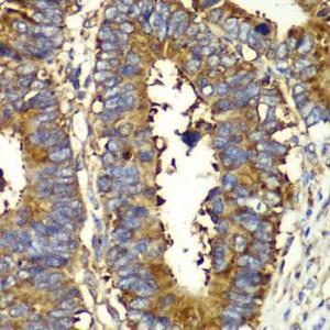 Immunohistochemistry analysis of paraffin-embedded human colon carcinoma tissue using Anti-GlnRS Antibody (A12047) at a dilution of 1:100 (40x lens). Perform microwave antigen retrieval with 10 mM PBS buffer pH 7.2 before commencing with IHC staining protocol.