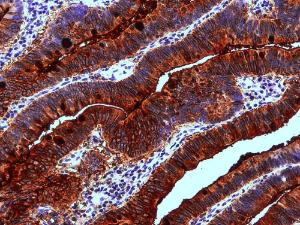 Immunohistochemistry staining of human colon adenocarcinoma (paraffin-embedded sections) with Anti-Blood Group Lewis a Antibody (A85793)