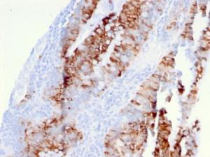 Immunohistochemical analysis of formalin-fixed, paraffin-embedded human colon carcinoma using Anti-CD262 Antibody [DR5/3381]