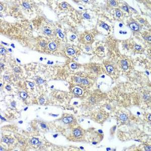 Immunohistochemistry analysis of paraffin-embedded human liver damage using Anti-GlnRS Antibody (A12047) at a dilution of 1:100 (40x lens). Perform microwave antigen retrieval with 10 mM PBS buffer pH 7.2 before commencing with IHC staining protocol.