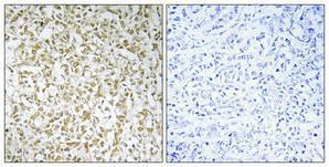 Immunohistochemical analysis of paraffin-embedded human breast cancer using Anti-CERKL Antibody 1:100 (4°C overnight). The right hand panel represents a negative control, where the antibody was pre-incubated with the immunising peptide