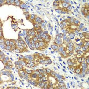 Immunohistochemistry analysis of paraffin-embedded human gastric cancer using Anti-GlnRS Antibody (A12047) at a dilution of 1:100 (40x lens). Perform microwave antigen retrieval with 10 mM PBS buffer pH 7.2 before commencing with IHC staining protocol.