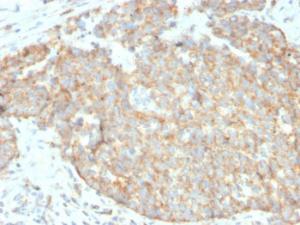 Immunohistochemical analysis of formalin-fixed, paraffin-embedded human breast carcinoma using Anti-CD262 Antibody [DR5/3381]