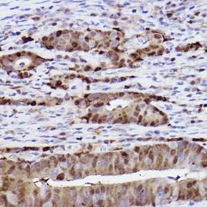 Immunohistochemistry analysis of paraffin-embedded human colon carcinoma tissue using Anti-SQSTM1/p62 Antibody [ARC0180] (A306736) at a dilution of 1:100 (40X lens). Perform high pressure antigen retrieval with 10 mM citrate buffer pH 6.0 before commencing with IHC staining protocol