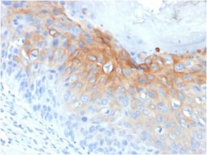 Immunohistochemical analysis of formalin-fixed, paraffin-embedded human cervical carcinoma using Anti-Cytokeratin 1 Antibody [KRT1/1840]