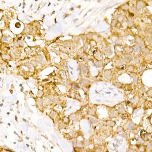 Immunohistochemistry analysis of paraffin-embedded human breast cancer tissue using Anti-HPS2 Antibody (A12057) at a dilution of 1:100 (40x lens)