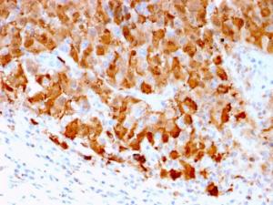 Immunohistochemical analysis of formalin-fixed, paraffin-embedded human melanoma using Anti-S100A1 Antibody [S100A1/1942]