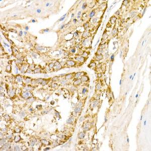 Immunohistochemistry analysis of paraffin-embedded human lung cancer using Anti-HPS2 Antibody (A12057) at a dilution of 1:100 (40x lens). Perform high pressure antigen retrieval with 10 mM citrate buffer pH 6.0 before commencing with IHC staining protocol