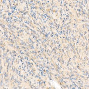 Immunohistochemistry analysis of paraffin-embedded human gastrointestinal stromal tumor using Anti-SDHB Antibody (A309465) at a dilution of 1:50 (40x lens). Perform high pressure antigen retrieval with 10 mM Tris/EDTA buffer pH 9.0 before commencing with IHC staining protocol.