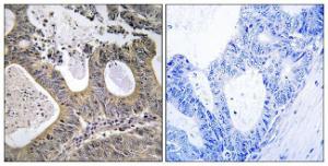 Immunohistochemical analysis of paraffin-embedded human colon carcinoma tissue using Anti-STEA2 Antibody The right hand panel represents a negative control, where the antibody was pre-incubated with the immunising peptide