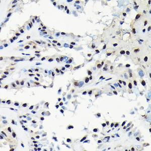 Immunohistochemistry analysis of paraffin-embedded human thyroid cancer using Anti-EFTUD2 Antibody (A12061) at a dilution of 1:100 (40x lens). Perform high pressure antigen retrieval with 10 mM citrate buffer pH 6.0 before commencing with IHC staining protocol.