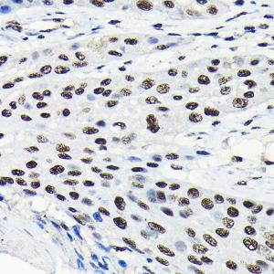 Immunohistochemistry analysis of paraffin-embedded human esophageal cancer using Anti-EFTUD2 Antibody (A12061) at a dilution of 1:100 (40x lens). Perform high pressure antigen retrieval with 10 mM citrate buffer pH 6.0 before commencing with IHC staining protocol.