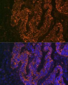 Immunofluorescence analysis of human colon carcinoma cells using Anti-CEACAM6 Antibody [ARC2110] (A306750) at a dilution of 1:100 (40X lens). DAPI was used to stain the cell nuclei (blue)