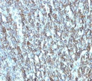 Immunohistochemical analysis of formalin-fixed, paraffin-embedded human breast carcinoma tissue using Anti-Migfilin Antibody [FBLIM1/4600] at 2 µg/ml