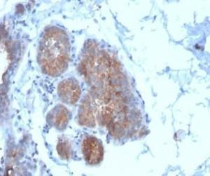 Immunohistochemical analysis of formalin-fixed, paraffin-embedded human breast carcinoma tissue using Anti-Migfilin Antibody [FBLIM1/4600] at 2 µg/ml