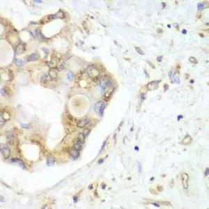 Immunohistochemistry analysis of paraffin-embedded human liver cancer using Anti-VTI1B Antibody (A12064) at a dilution of 1:100 (40X lens). Perform microwave antigen retrieval with 10 mM PBS buffer pH 7.2 before commencing with IHC staining protocol