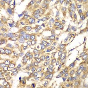 Immunohistochemistry analysis of paraffin-embedded human esophageal cancer using Anti-VTI1B Antibody (A12064) at a dilution of 1:100 (40X lens). Perform microwave antigen retrieval with 10 mM PBS buffer pH 7.2 before commencing with IHC staining protocol