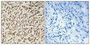 Immunohistochemical analysis of paraffin-embedded human breast cancer using Anti-SPIN1 Antibody 1:100 (4 °C overnight). The right hand panel represents a negative control, where the Antibody was pre-incubated with the immunising peptide