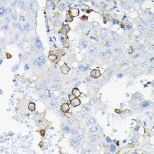 Immunohistochemistry analysis of paraffin-embedded human liver cancer using Anti-ILT-3 Antibody (A12068) at a dilution of 1:100 (40x lens). Perform high pressure antigen retrieval with 10 mM citrate buffer pH 6.0 before commencing with IHC staining protocol.