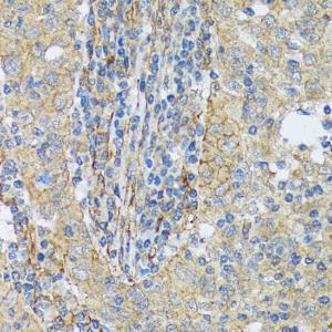 Immunohistochemistry analysis of paraffin-embedded human esophageal cancer using Anti-Cortactin Antibody [ARC1613] (A307999) at a dilution of 1:100 (40x lens). Perform microwave antigen retrieval with 10 mM Tris/EDTA buffer pH 9.0 before commencing with IHC staining protocol.