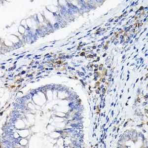 Immunohistochemistry analysis of paraffin-embedded human colon carcinoma tissue using Anti-ILT-3 Antibody (A12068) at a dilution of 1:100 (40x lens). Perform high pressure antigen retrieval with 10 mM citrate buffer pH 6.0 before commencing with IHC staining protocol.