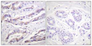 Immunohistochemical analysis of paraffin-embedded human breast carcinoma using Anti-p70 S6 Kinase (phospho Thr389) Antibody. The right hand panel represents a negative control, where the antibody was pre-incubated with the immunising peptide