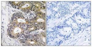 Immunohistochemical analysis of paraffin-embedded human colon carcinoma using Anti-TRAPPC6A Antibody. The right hand panel represents a negative control, where the Antibody was pre-incubated with the immunising peptide