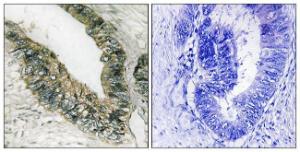 Immunohistochemical analysis of paraffin-embedded human colon carcinoma using Anti-PERK Antibody. The right hand panel represents a negative control, where the antibody was pre-incubated with the immunising peptide