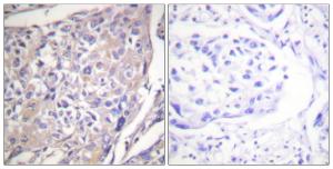 Immunohistochemical analysis of paraffin-embedded human breast carcinoma using Anti-p70 S6 Kinase (phospho Ser418) Antibody. The right hand panel represents a negative control, where the antibody was pre-incubated with the immunising peptide