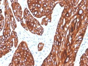 Immunohistochemical analysis of formalin-fixed, paraffin-embedded human squamous cell carcinoma using Anti-Cytokeratin 5 Antibody [rKRT5/6398]