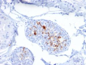 Immunohistochemical analysis of formalin-fixed, paraffin-embedded human breast carcinoma using Anti-ZNF690 Antibody [ZSCAN29/2610]