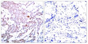 Immunohistochemical analysis of paraffin-embedded human breast carcinoma using Anti-NF-kappaB p65 (phospho Ser536) Antibody. The right hand panel represents a negative control, where the antibody was pre-incubated with the immunising peptide