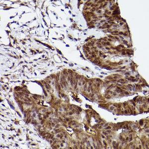 Immunohistochemistry analysis of paraffin-embedded human colon carcinoma tissue using Anti-ERK1 Antibody [ARC2591] (A306776) at a dilution of 1:100 (40x lens)