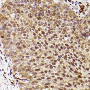 Immunohistochemistry analysis of paraffin-embedded human lung cancer using Anti-ERK1 Antibody [ARC2591] (A306776) at a dilution of 1:100 (40x lens)