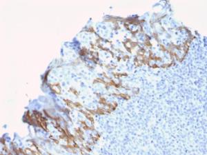 Immunohistochemical analysis of formalin-fixed, paraffin-embedded human breast carcinoma using Anti-ZNF690 Antibody [ZSCAN29/2610]