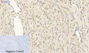 Immunohistochemical analysis of paraffin-embedded human uterus cancer tissue using Anti-Smad3 Antibody at 1:200 (4°C overnight) Negative control was secondary antibody only