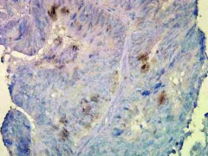 Immunohistochemistry analysis of human colon carcinoma, fixed in formali