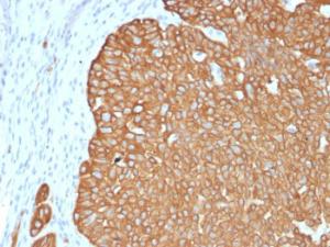 Immunohistochemical analysis of formalin-fixed, paraffin-embedded human basal cell carcinoma using Anti-Cytokeratin 5 Antibody [KRT5/4245R]