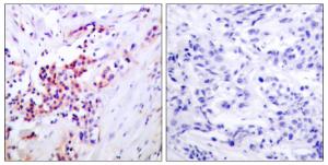 Immunohistochemical analysis of paraffin-embedded human breast carcinoma using Anti-NF-kappaB p65 (phospho Ser468) Antibody. The right hand panel represents a negative control, where the antibody was pre-incubated with the immunising peptide.