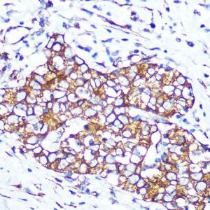 Immunohistochemistry analysis of paraffin-embedded human esophageal cancer using Anti-Pannexin 1 Antibody [ARC1207] (A305603) at a dilution of 1:100 (40X lens). Perform microwave antigen retrieval with 10 mM PBS buffer pH 7.2 before commencing with IHC staining protocol