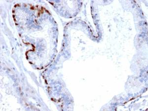 Immunohistochemical analysis of formalin-fixed, paraffin-embedded human prostate carcinoma using Anti-Cystatin A Antibody [CPTC-CSTA-1]